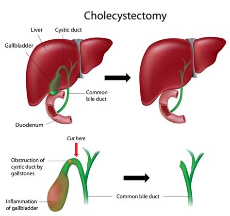 bile leakage symptoms|Gallbladder removal